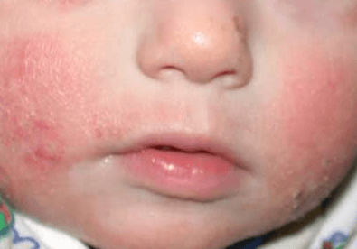 bebeklerde atopik dermatit